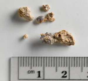 Sua kidney stones