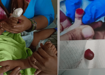 ಬೆಂಗಳೂರಿನಲ್ಲಿ ವೈದ್ಯರ ನಿರ್ಲಕ್ಷ್ಯ! 6 ತಿಂಗಳ ಮಗುವಿನ ಬೆರಳೇ ಕಟ್