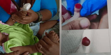 ಬೆಂಗಳೂರಿನಲ್ಲಿ ವೈದ್ಯರ ನಿರ್ಲಕ್ಷ್ಯ! 6 ತಿಂಗಳ ಮಗುವಿನ ಬೆರಳೇ ಕಟ್