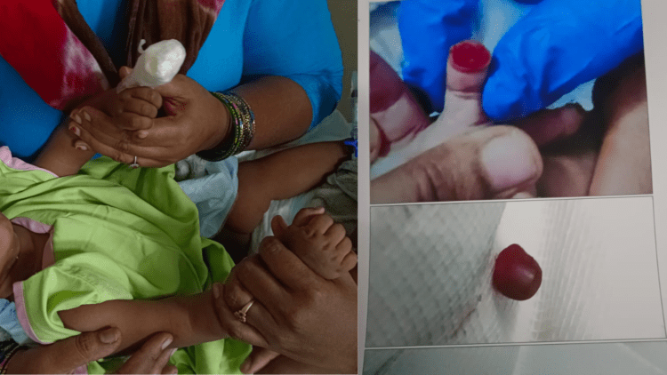 ಬೆಂಗಳೂರಿನಲ್ಲಿ ವೈದ್ಯರ ನಿರ್ಲಕ್ಷ್ಯ! 6 ತಿಂಗಳ ಮಗುವಿನ ಬೆರಳೇ ಕಟ್